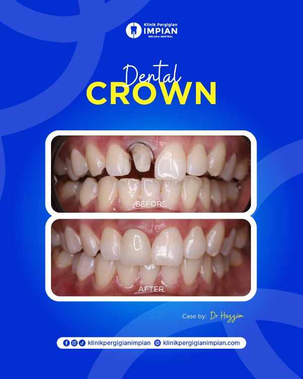 crown-1
