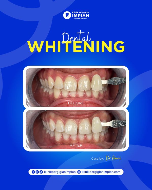 whitening2